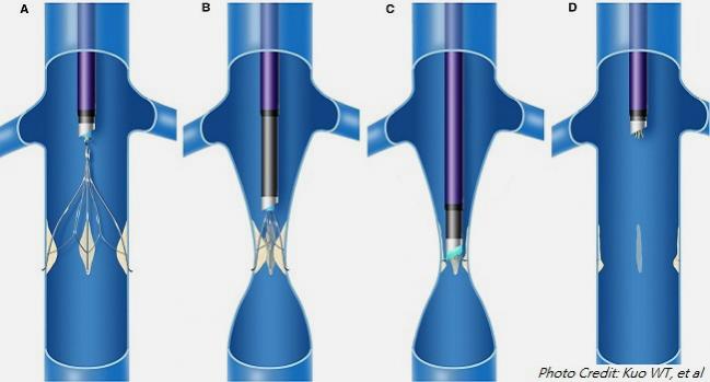 Lasers Can Aid Retrieval Of Stubborn IVC Filters Tctmd Lasers Can Aid Retrieval Of Stubborn IVC Filters Tctmd